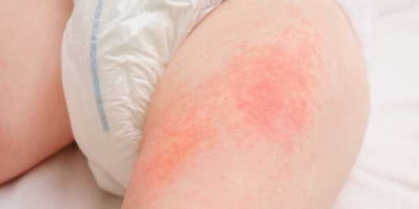 How To Treat And Prevent Diaper Rash Effectively